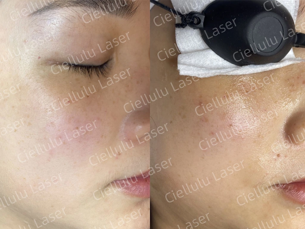 Tratamentos para remoção de acne: entenda suas opções para uma pele mais clara