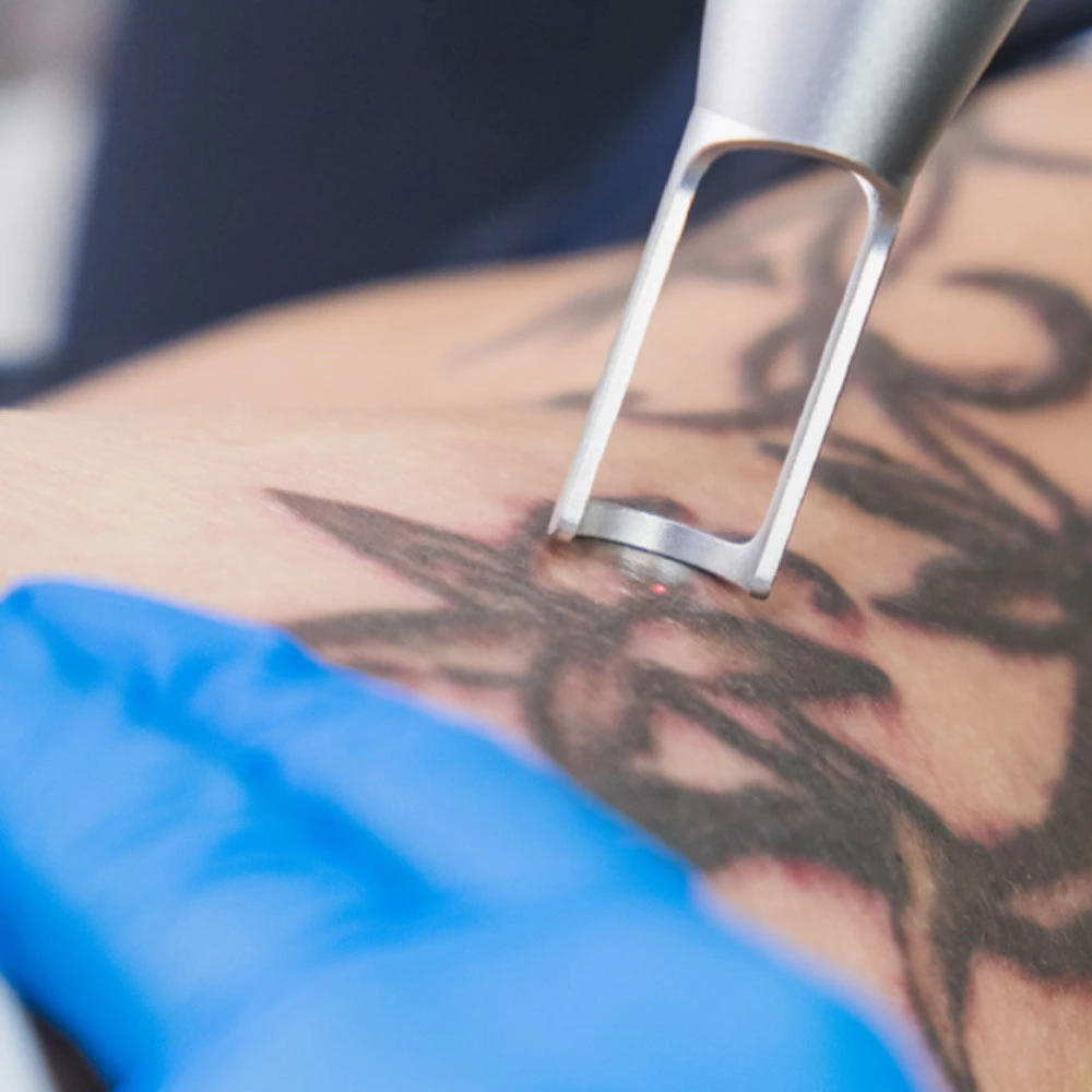 Remoção de Tatuagem: Opções e Resultados